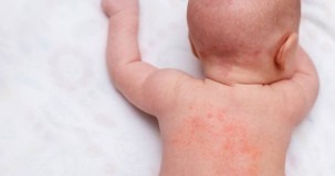 Bebeklerde Görülen Cilt Hastalıkları ve Döküntüler: Belirtiler, Enfeksiyonlar ve Tedavi Yöntemleri