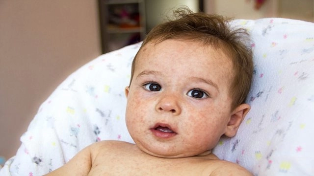 Bebeklerde Görülen Cilt Hastalıkları Nelerdir?